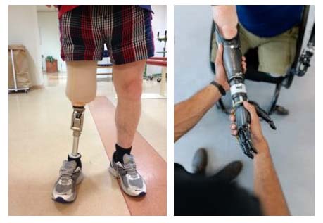 ispo-prothesis1